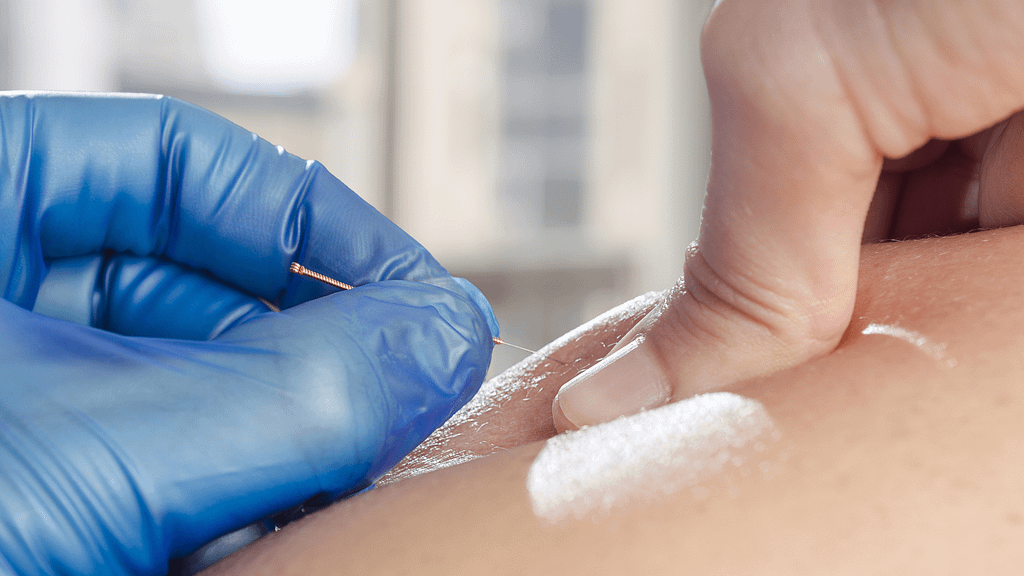 Dry Needling